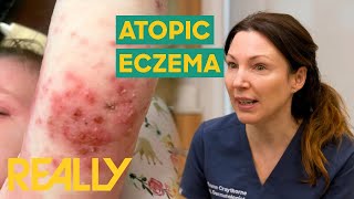 Toddler With Severe Form Of Eczema Visits Dr Emma  The Bad Skin Clinic [upl. by Au]