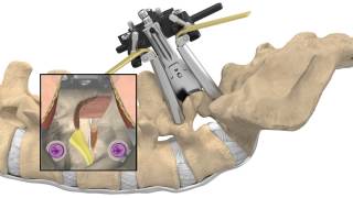 MAS® TLIF Patient Animation [upl. by Holds]