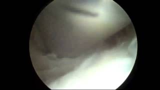 Endoscopic Olecranon Bursa Excision at Elbow by Houston TX Orthopedic Surgeon Dr Jeffrey E Budoff [upl. by Dafodil]