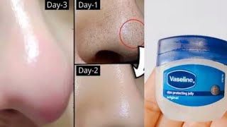 how to remove blackheads whiteheads with vaseline how to remove blackheads from nose at home [upl. by Suirrad]