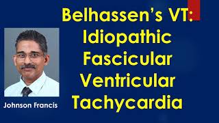 Belhassen’s VT Idiopathic Fascicular Ventricular Tachycardia [upl. by Ereynihc]