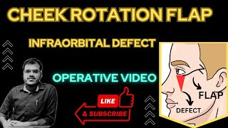 CHEEK ROTATION FLAP WITH ZPLASTY [upl. by Ayhtin]