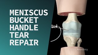 Meniscus Bucket Handle Tear Repair [upl. by Einnhoj707]