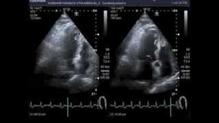 Bicycle stress echocardiography [upl. by Babcock328]