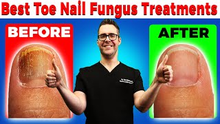 Best Toe Nail Fungus Treatments Onychomycosis Remedies [upl. by Coonan419]