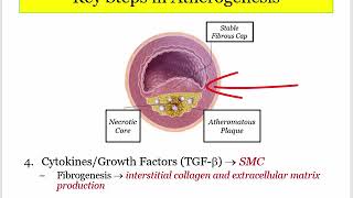 12DaysinMarch ASHD1 Atherogenesis for the USMLE Step One Exam [upl. by Imelida]