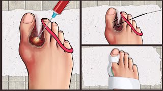 ASMR Treatment Athletes foot and warts between toes at home  Foot care animation [upl. by Ailadgim124]