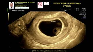 Subchorinic Haematoma 8 weeks [upl. by Seyler]