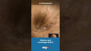 बच्चेदानी Uterus का Dilation और Curettage  Procedure for removing unwanted tissue in uterus [upl. by Farrish]