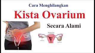 Cara Menghilangkan kista ovarium secara alami [upl. by Otokam]