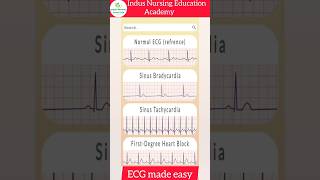 ECG Made Easy ecg mbbs neet ecginterpretation nursing youtubeshorts viral trending shorts [upl. by Pence620]