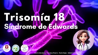 Trisomía 18 ‐ Síndrome de Edwards [upl. by Je]