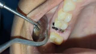 EXTRACTION OF RIGHT UPPER MAXILLARY MOLAR ROOT STUMP BROKEN CROWN [upl. by Pavel]