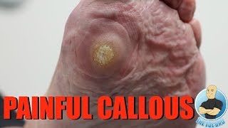 HUGE PAINFUL CALLOUS REMOVAL AND HOW TO STOP IT FROM GROWING [upl. by Donovan]