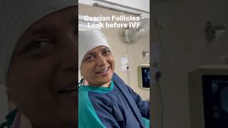 Ovarian Follicles  Look before IVF eggpick ovary fertility opudranshudrsuniljindal [upl. by Stanislas272]