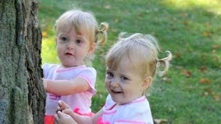 Conjoined Twins Learn to Live Apart [upl. by Wilhelmine]