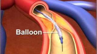 Percutaneous coronary Intervention stenting [upl. by Esital]