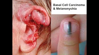 Basal Cell Carcinoma amp Melanonychia Nail Lines Updated [upl. by Enwad]