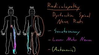 Syndrome Radiculopathy [upl. by Earissed]