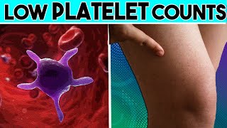 Causes Signs and symptoms of Low platelet count Thrombocytopenia  Low Platelet count [upl. by Goldin]