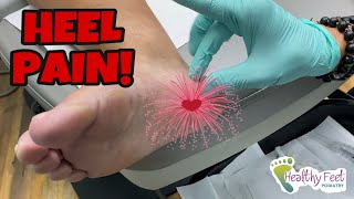 PLANTAR FASCIITIS TREATMENT STRETCHES AND HOME REMEDIES [upl. by Michella]