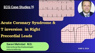 ECG Case Studies 1 Acute Coronary Syndrome with T inverion in right precodeal leads [upl. by Halverson]