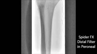 Peroneal Artery and Posterior Tibial PTA amp Atherectomy [upl. by Mcgaw600]