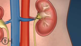 Kidney Stones in Children Amandas Story 5 of 5 [upl. by Ameerak]