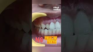 Say NO to Yellow Teeth Teeth Whitening Process Dr Srishti Bhatia smile teethwhitening [upl. by Nylrac]