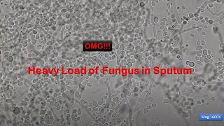 Heavy load of fungus in the Sputum specimen Microscopy at 400X 800X and 1600X [upl. by Eikcor488]