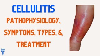 CELLULITIS Pathophysiology Types Treatment Symptoms amp Nursing Interventions [upl. by Yoral]