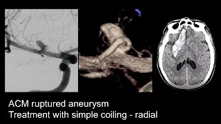 Ruptured Aneurysm Right MCA  Coiling  Radial [upl. by Grissel]