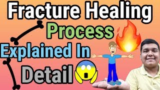 FractureBone Healing Process Explained [upl. by Trixi]