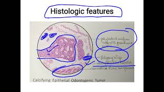 calcifying epithelial odontogenic tumour [upl. by Capriola33]