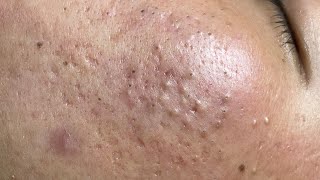 Blackheads amp Pimples Pore Removal New 2024FULL  Acne Treatment With Bo Nguyễn Spa [upl. by Aleece]