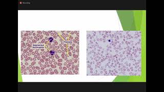 Hematology PEDIATRICS Cong hemolytic anemia amp IMNCI [upl. by Eolande]