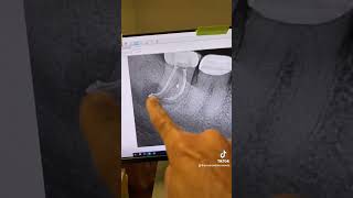 Still not convinced one appointment RCT on an abscessed tooth works Watch this video [upl. by Hamas884]