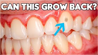 Can Tooth Enamel Grow Back How To Prevent Enamel Erosion [upl. by Keryt61]