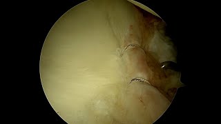 Probing the Labrum Assess Its Stability Following Arthroscopic Repair [upl. by Raleigh]