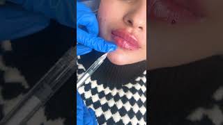 Russian Lip Filler Tenting Technique  Dermalyn Aesthetics  Permanent Makeup Clinic [upl. by Adlen595]