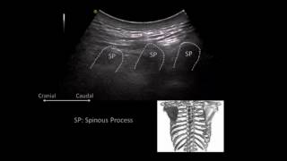 Sonographic tracking of trunk nerve  123828 [upl. by Jaddo]