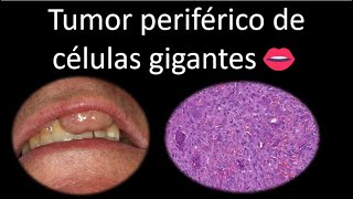 👄 Tumor periférico de células gigantes  Cavidad oral  Cabeza y Cuello  Patología [upl. by Brier683]