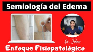 Semiología del EDEMA  Enfoque Fisiopatológico [upl. by Eiahpets493]