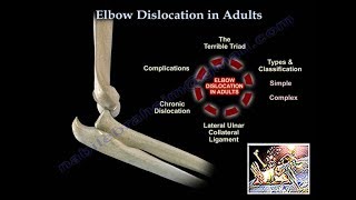 Elbow Dislocation In Adults  Everything You Need To Know  Dr Nabil Ebraheim [upl. by Adnamas245]