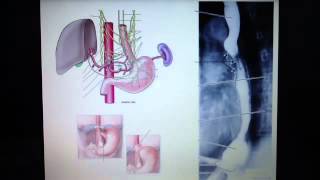 Esophagus  innervation and clinical correlates [upl. by Esilehc]