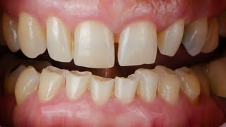 BRUXISM CAUSES SYMPTOMS What is Bruxism [upl. by Macdermot321]