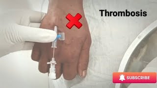 IV Cannula practiceCannula success but thrombosis [upl. by Edyth470]