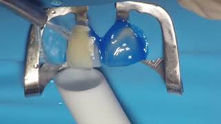 Porcelain Veneer Cementation  Adehesive protocol in the Rubberdam isolation [upl. by Laurin]