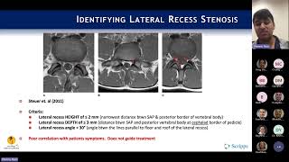 Neurogenic Claudication  Lateral Recess Stenosis  Ryan Khanna MD [upl. by Thinia]