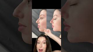 Filler before amp after filler lipfiller chinfiller nosefiller beforeandafter botox fillers [upl. by Etteiluj256]